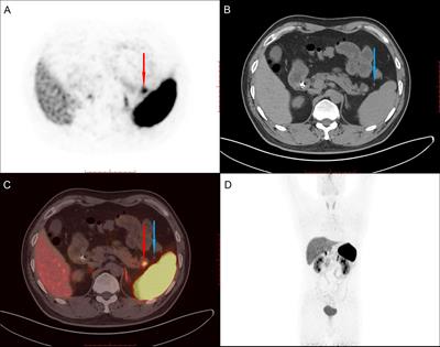 Laparoscopic treatment for an intrapancreatic accessory spleen: A case report